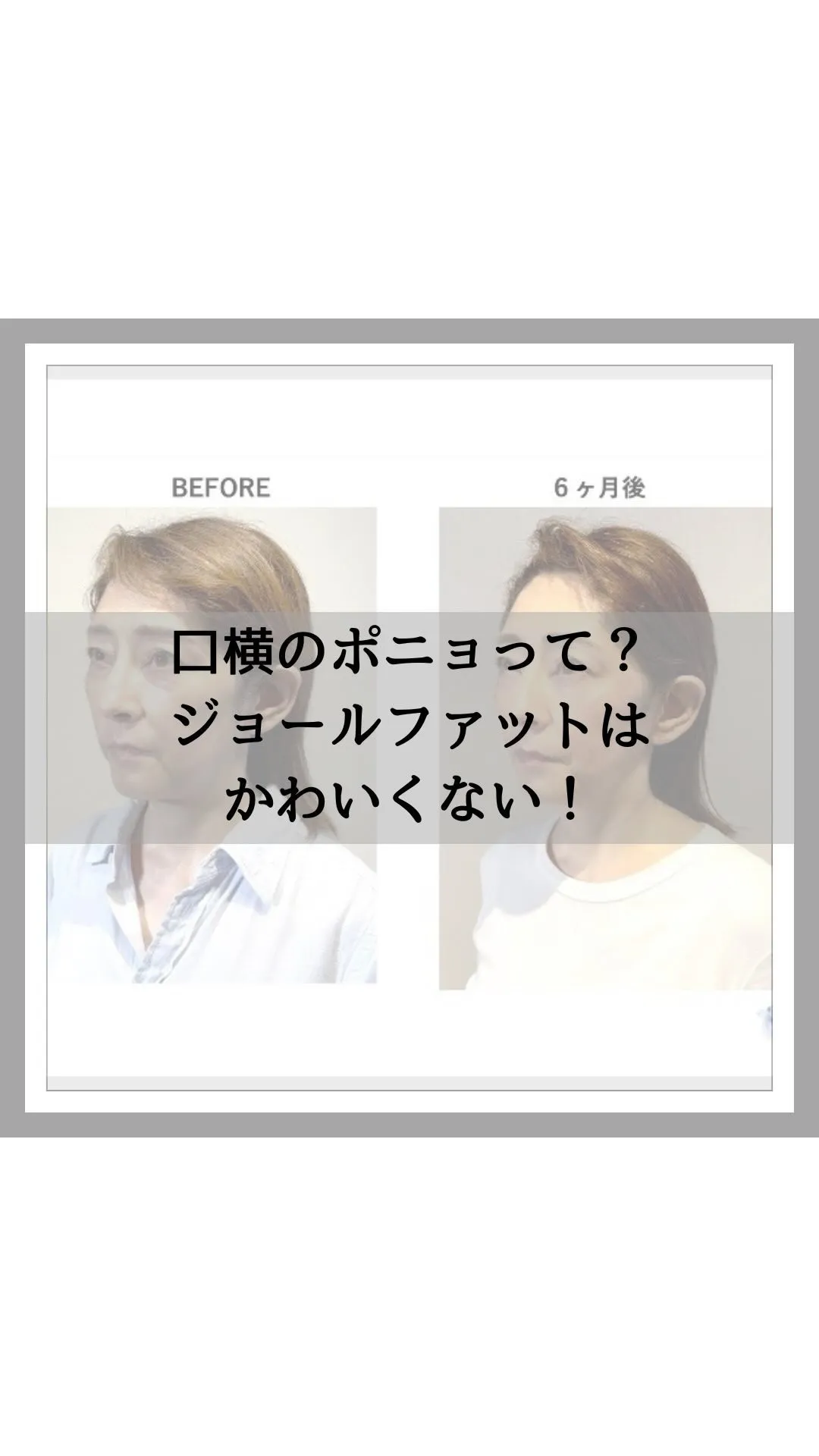 最近、「口横ポニョ」という、顔の脂肪が蓄積しぷくっと膨れる現...