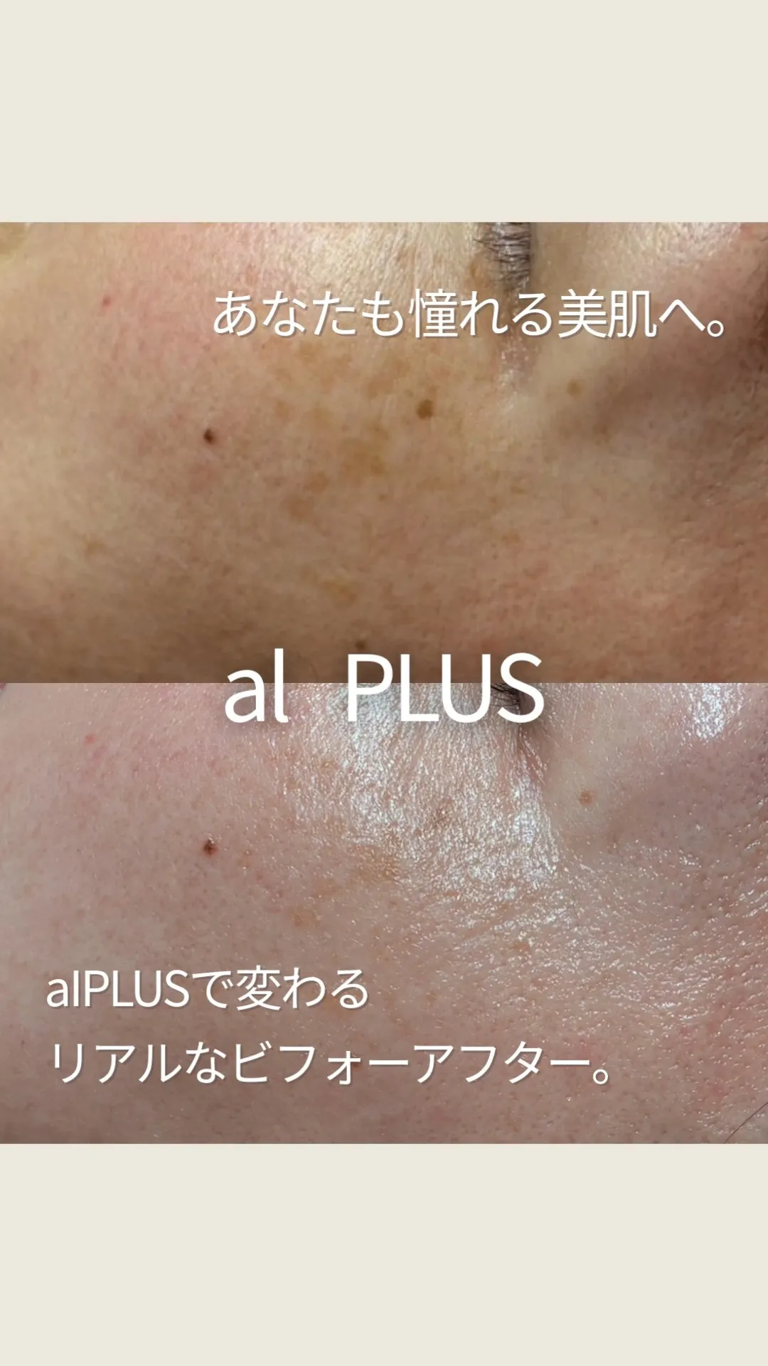 αIPLUS光フェイシャルで